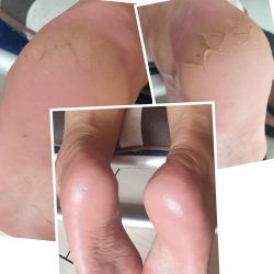 Gabinet Podologiczny Katarzyna Stec Leczenie i pielęgnacja pękających pięt
